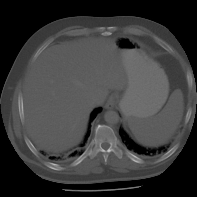 Appendicitis with perforation (Radiopaedia 35790-37342 Axial bone window 7).jpg