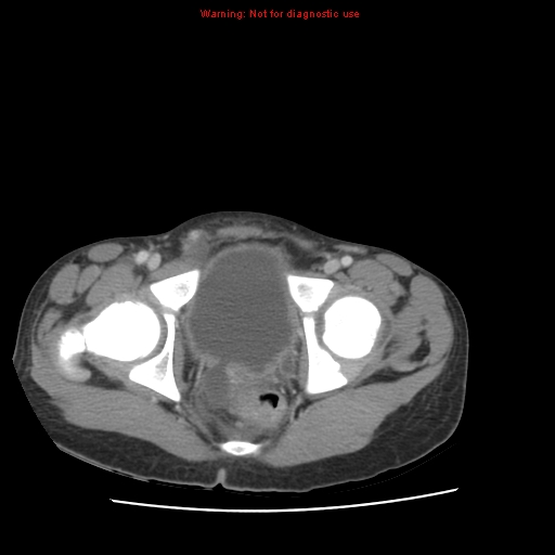 File:Appendicitis with phlegmon (Radiopaedia 9358-10046 A 67).jpg