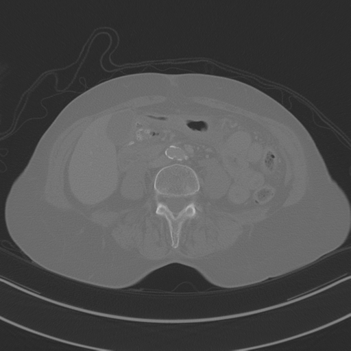 April fools' 2019- calcified peritoneal arachnoidosis (Radiopaedia 67273-76636 Axial bone window 24).png