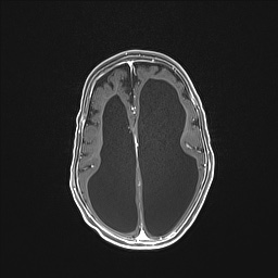 Aqueductal stenosis (Radiopaedia 73974-84802 Axial T1 C+ 98).jpg