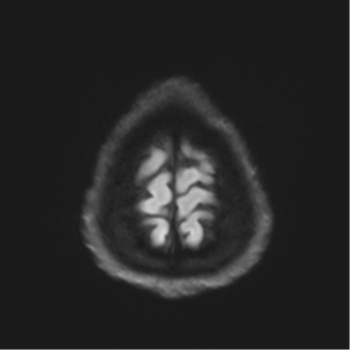 File:Arachnoid cyst - cerebellopontine angle (Radiopaedia 59689-67083 Axial DWI 70).png
