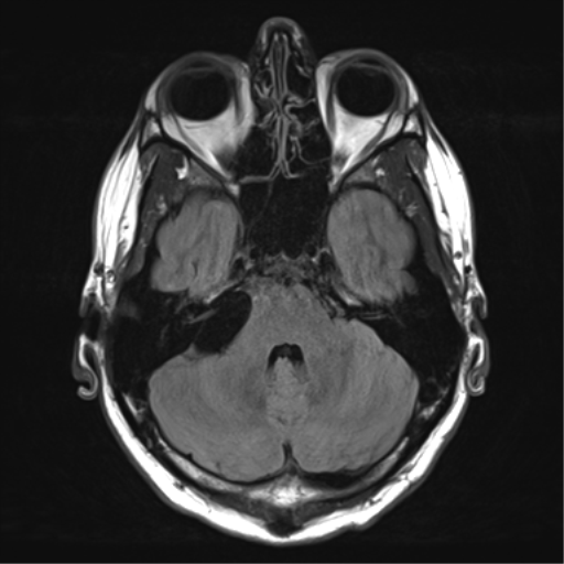 File:Arachnoid cyst - cerebellopontine angle (Radiopaedia 59689-67083 Axial FLAIR 10).png