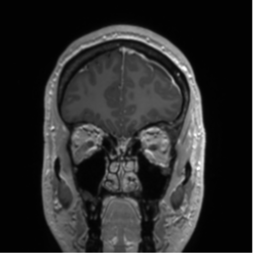 Arachnoid cyst with subdural hematoma (Radiopaedia 85892-101743 Coronal T1 C+ 75).png