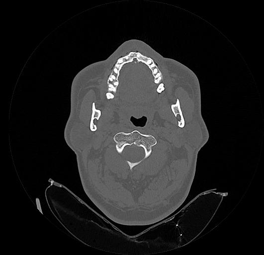 Arcuate foramen (Radiopaedia 89833-106944 Axial bone window 53).jpg