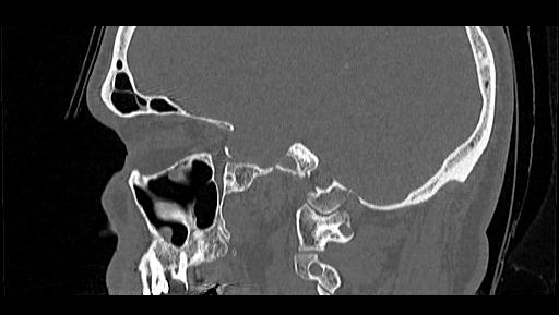 Arcuate foramen (Radiopaedia 89833-106944 Sagittal bone window 20).jpg