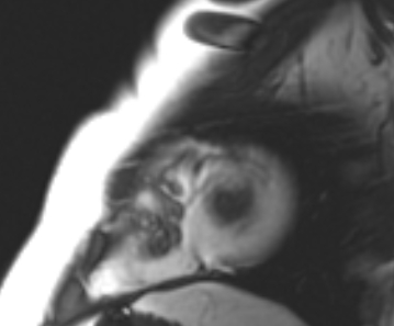 File:Arrhythmogenic right ventricular cardiomyopathy (Radiopaedia 69431-79307 Short axis cine 8).jpg