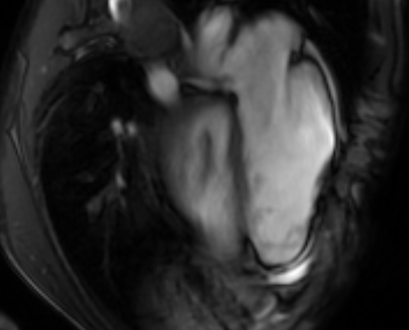 Arrhythmogenic right ventricular cardiomyopathy (Radiopaedia 69564-79464 4ch cine 116).jpg