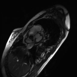 Arrhythmogenic right ventricular cardiomyopathy (Radiopaedia 87505-103850 short axis Cine SSFP 241).jpg