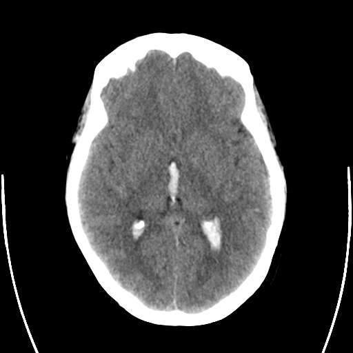 File:Arteriovenous malformation (cerebral) (Radiopaedia 40070-42579 Axial non-contrast 16).png