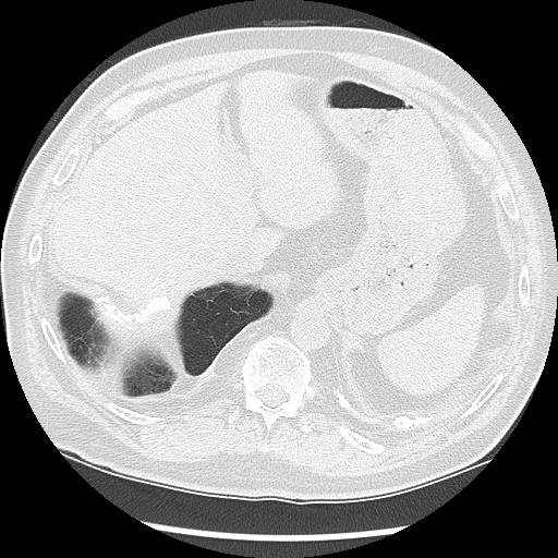 Asbestos-related pleural disease (Radiopaedia 74366-85250 Axial lung window 102).jpg
