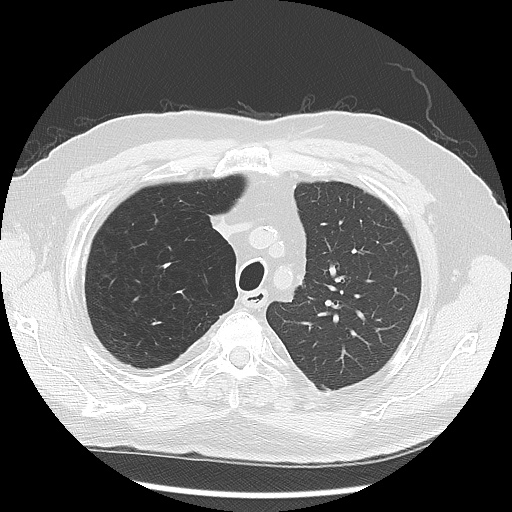 Asbestos-related pleural disease (Radiopaedia 74366-85250 Axial lung window 30).jpg