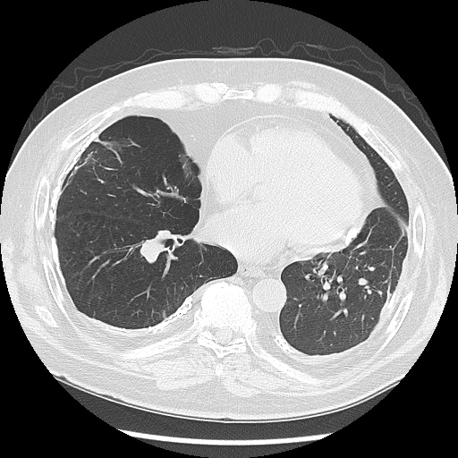 Asbestos-related pleural disease (Radiopaedia 74366-85250 Axial lung window 73).jpg