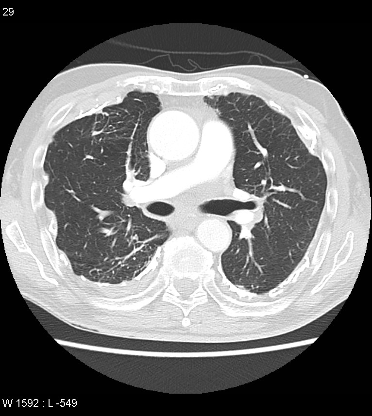 Asbestos related lung and pleural disease (Radiopaedia 14377-14301 A 26).jpg