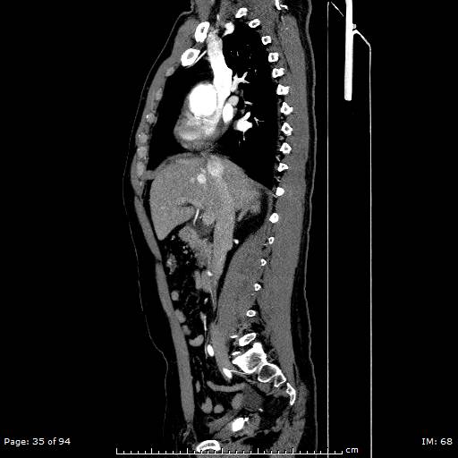 File:Ascending aortic aneurysm (Radiopaedia 50086-55404 C 25).jpg