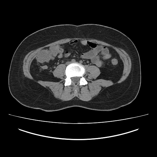 Ascending retrocecal appendicitis with liver abscesses (Radiopaedia 60066-67615 Axial non-contrast 53).jpg