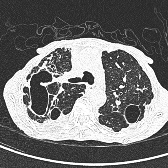 Aspergilloma- with Monod sign (Radiopaedia 44737-48532 Axial lung window 92).jpg