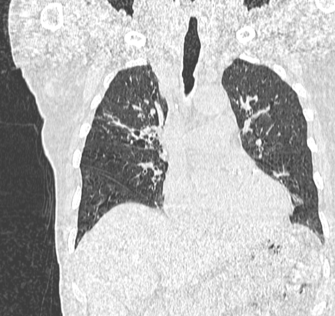 Aspergilloma (Radiopaedia 44592-48327 Coronal lung window 51).jpg