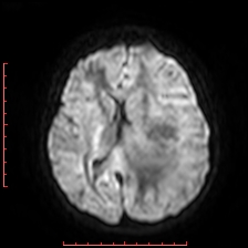 File:Astroblastoma (Radiopaedia 74287-85162 Axial DWI 58).jpg