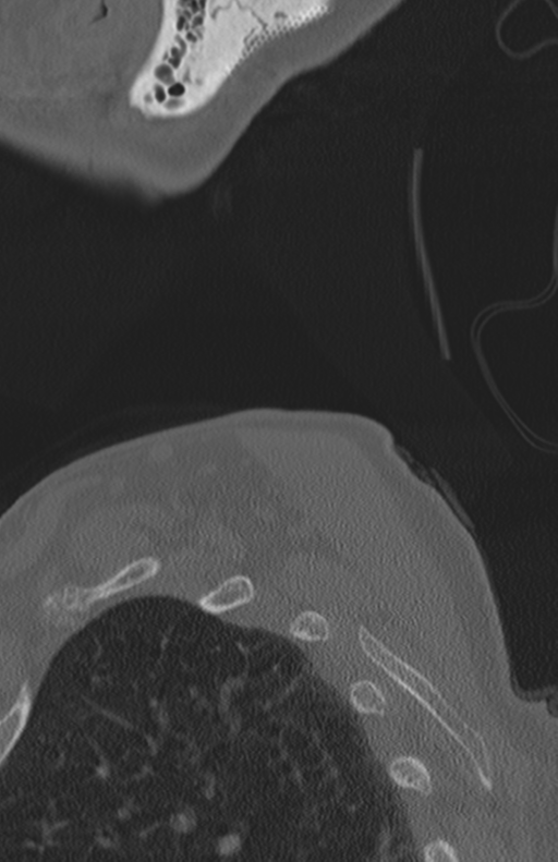 Atlanto-axial subluxation (Radiopaedia 36610-38176 Sagittal bone window 80).png