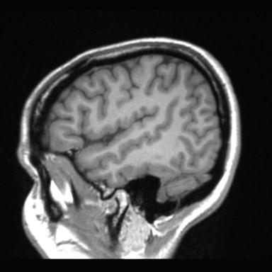 File:Atretic encephalocoele with inferior vermis hypoplasia (Radiopaedia 30443-31108 Sagittal T1 22).jpg