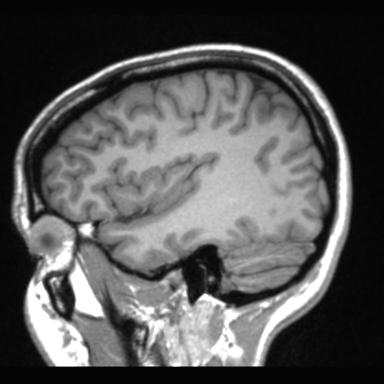 Atretic encephalocoele with inferior vermis hypoplasia (Radiopaedia 30443-31108 Sagittal T1 29).jpg