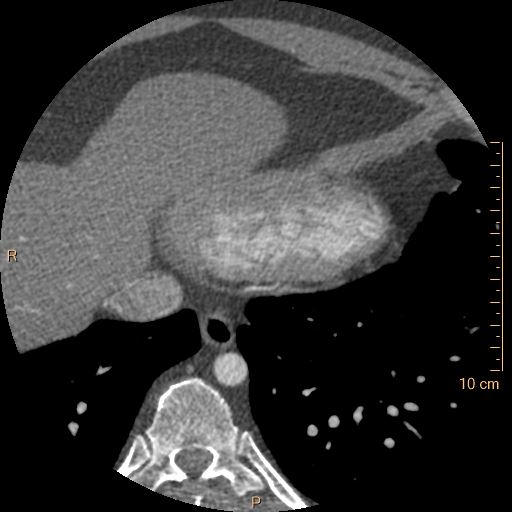 Atrial septal defect (upper sinus venosus type) with partial anomalous pulmonary venous return into superior vena cava (Radiopaedia 73228-83961 A 242).jpg