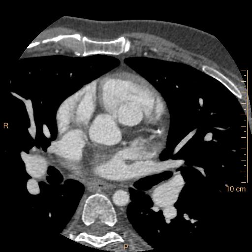 File:Atrial septal defect (upper sinus venosus type) with partial anomalous pulmonary venous return into superior vena cava (Radiopaedia 73228-83961 A 95).jpg