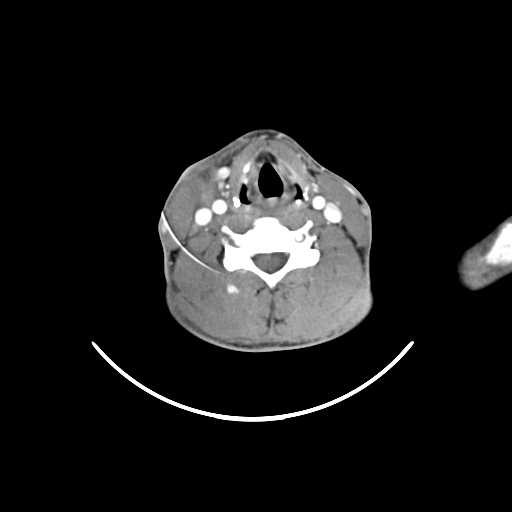 File:Atypical 2nd branchial cleft cyst (type IV) - infected (Radiopaedia 20986-20924 A 19).jpg