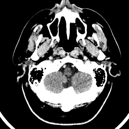 Atypical meningioma (WHO grade II) with brain invasion (Radiopaedia 57767-64728 Axial C+ 50).png