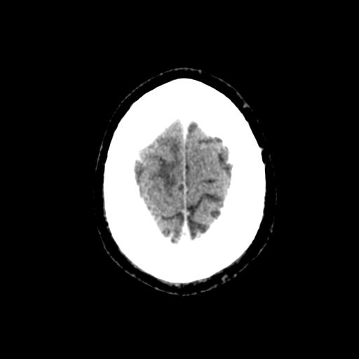 File:Atypical meningioma (WHO grade II) with brain invasion (Radiopaedia 57767-64728 Axial C+ 7).png