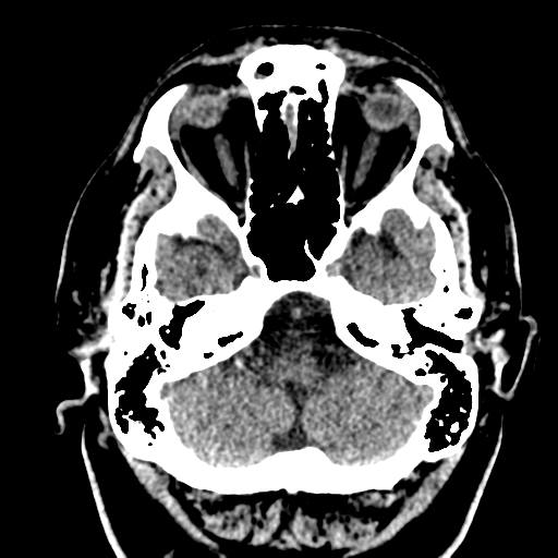 File:Atypical meningioma (WHO grade II) with brain invasion (Radiopaedia 57767-64728 Axial non-contrast 6).png