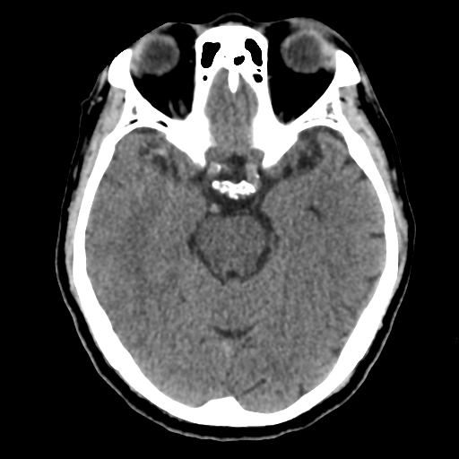 Atypical meningioma (WHO grade II) with osseous invasion (Radiopaedia 53654-59715 Axial non-contrast 21).png