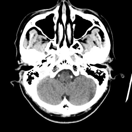 Atypical meningioma with skull invasion (Radiopaedia 34357-35649 Axial C+ delayed 11).png