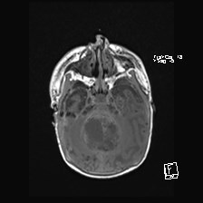Atypical teratoid rhabdoid tumor (prenatal US and neonatal MRI) (Radiopaedia 59091-66388 Axial T1 18).jpg