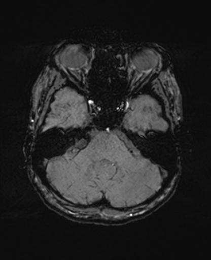 Autoimmune limbic encephalitis (Radiopaedia 30363-31005 SWI 19).jpg