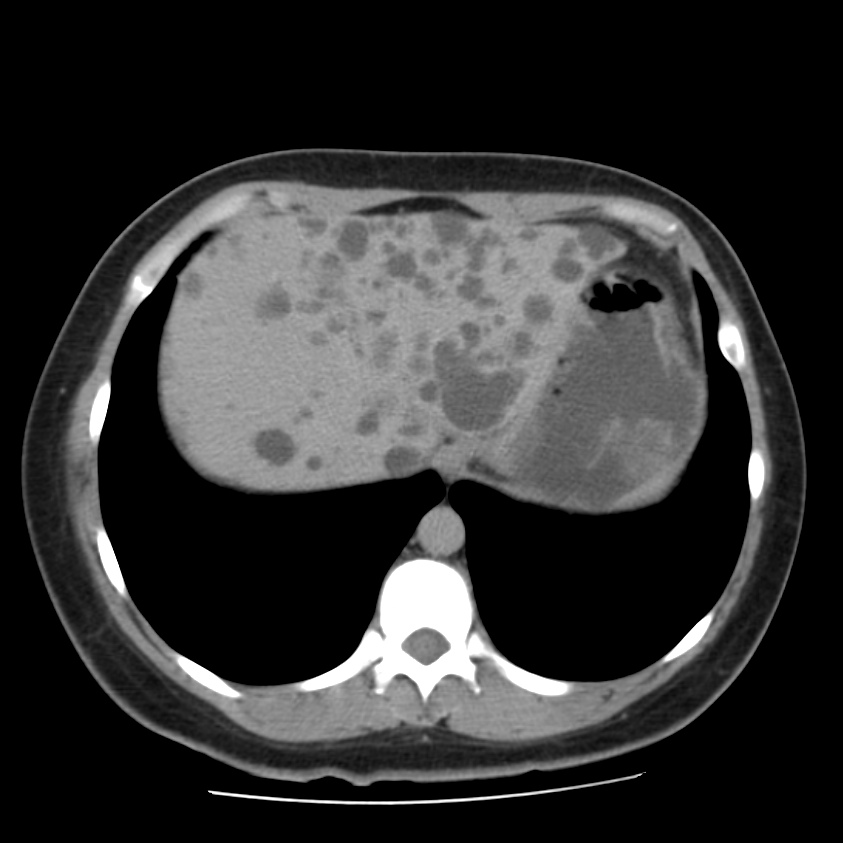 Autosomal dominant polycystic kidney disease (Radiopaedia 23061-23093 C+ delayed 10).jpg