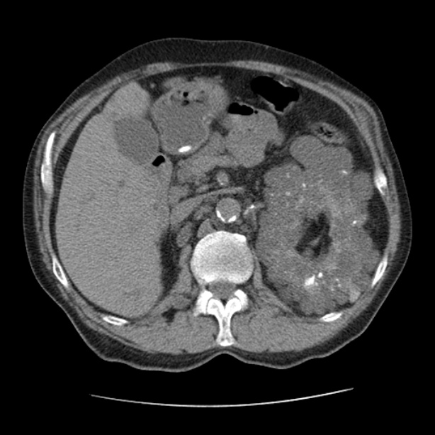 Autosomal dominant polycystic kidney disease (Radiopaedia 27851-28094 Axial non-contrast 64).jpg