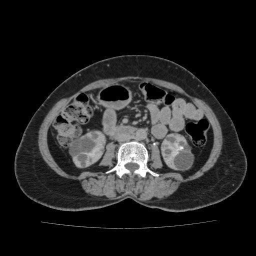 Autosomal dominant polycystic kidney disease (Radiopaedia 38189-40194 Axial C+ delayed 27).jpg