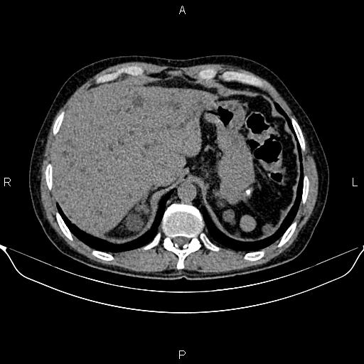 File:Autosomal dominant polycystic kidney disease (Radiopaedia 87830-104287 Axial non-contrast 12).jpg
