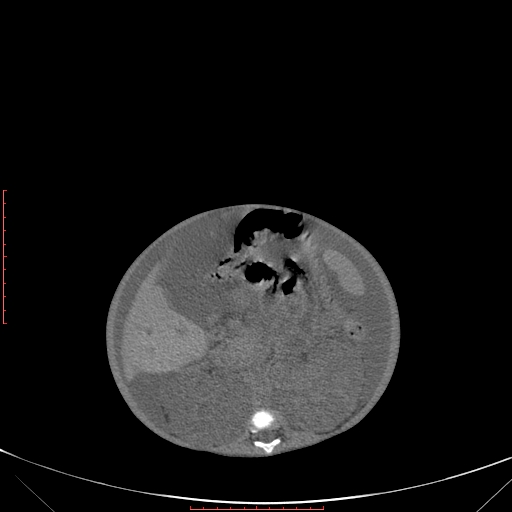 Autosomal recessive polycystic kidney disease associated with Caroli disease (Radiopaedia 61932-69984 B 202).jpg