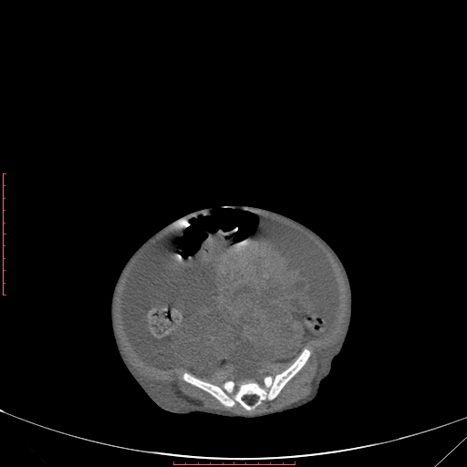 File:Autosomal recessive polycystic kidney disease associated with Caroli disease (Radiopaedia 61932-69984 B 284).jpg