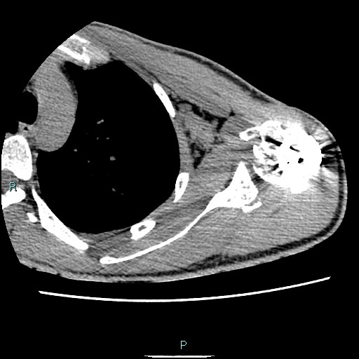 File:Avascular necrosis after fracture dislocations of the proximal humerus (Radiopaedia 88078-104653 D 45).jpg