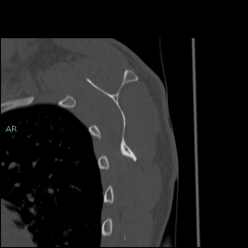 Avascular necrosis after fracture dislocations of the proximal humerus (Radiopaedia 88078-104653 Sagittal bone window 58).jpg