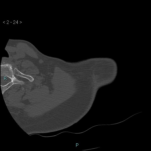 Avascular necrosis of the shoulder - Cruess stage I (Radiopaedia 77674-89887 Axial bone window 6).jpg