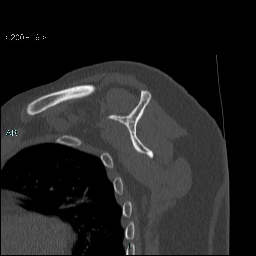 Avascular necrosis of the shoulder - Cruess stage I (Radiopaedia 77674-89887 Sagittal bone window 18).jpg