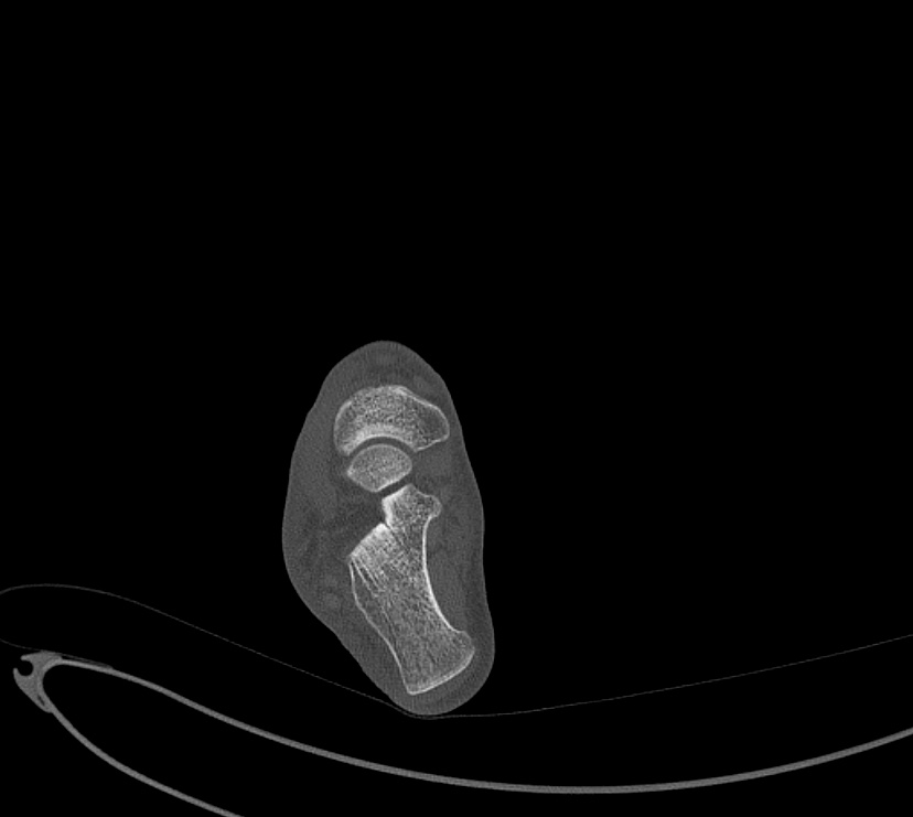 Avulsion fractures of talus and calcaneus (Radiopaedia 48277-53155 Axial bone window 56).jpg