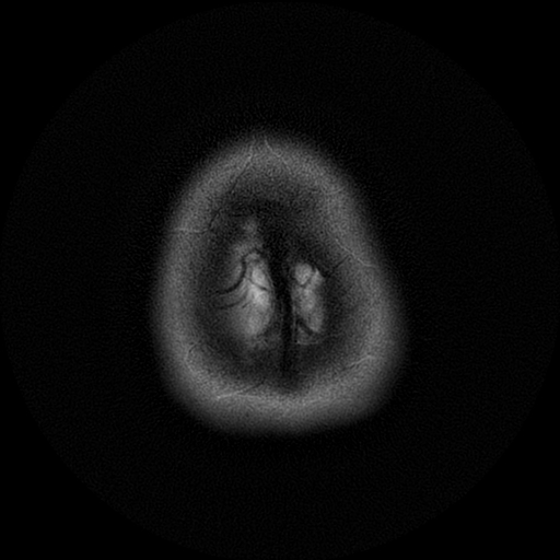 File:Azygos anterior cerebral artery (Radiopaedia 17059-16756 Axial T2 1).jpg