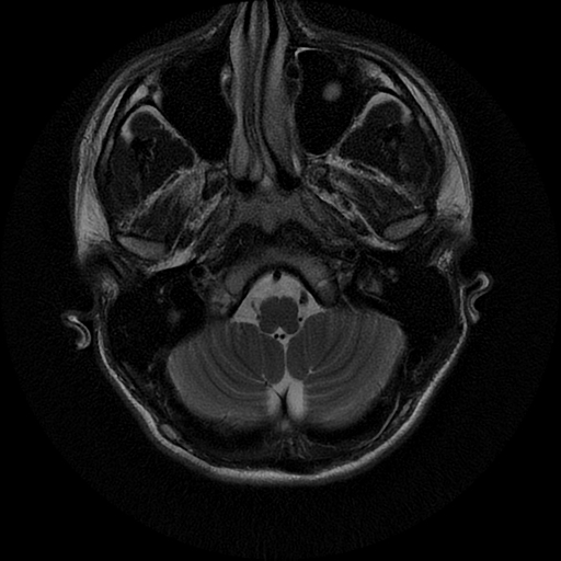 File:Azygos anterior cerebral artery (Radiopaedia 17059-16756 Axial T2 22).jpg