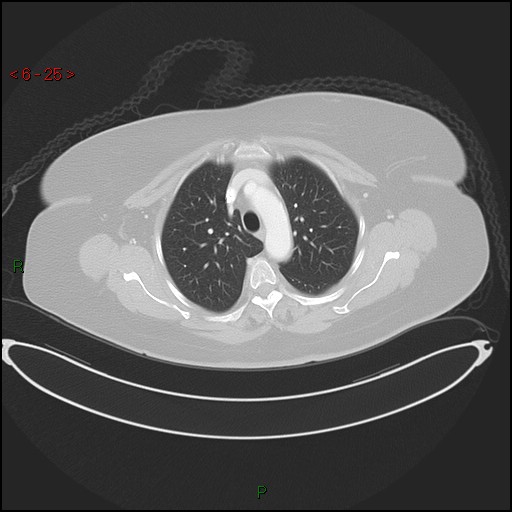 Azygos fissure and lobe (Radiopaedia 47620-52278 Axial lung window 25).jpg