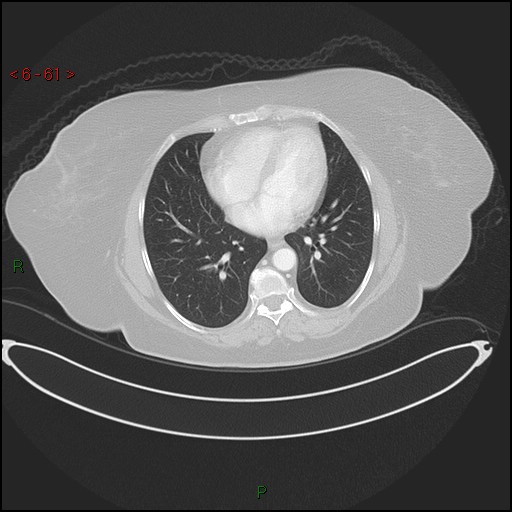 File:Azygos fissure and lobe (Radiopaedia 47620-52278 Axial lung window 61).jpg